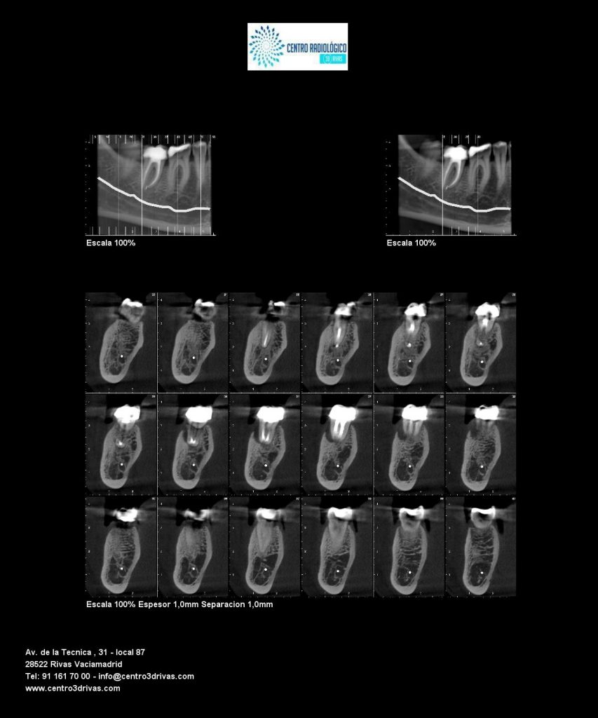 El Cbct En La Endodoncia Centro Radiológico 3d Rivas 6474